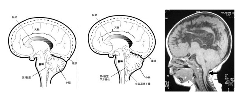 図1上段：顕在性（開放性）二分脊椎、脊髄髄膜瘤